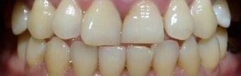6 Month Straight teeth before 3135235