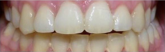 6 Month Straight teeth after 3135235