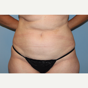45-54 year old woman treated with Tummy Tuck before 3588243