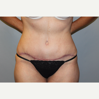 45-54 year old woman treated with Tummy Tuck after 3588243