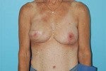 Stacked DIEP Flap Breast Reconstruction in Delayed/Immediate Setting after 1074130
