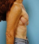 Stacked DIEP Flap Breast Reconstruction in Delayed/Immediate Setting 1074130