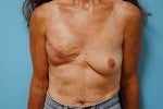 Stacked DIEP Flap Breast Reconstruction in Delayed/Immediate Setting before 1074130