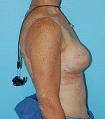 Stacked DIEP Flap Breast Reconstruction in Delayed/Immediate Setting 1074130