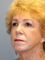 65-74 year old woman treated with Neck Lift before 3103938