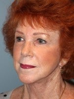65-74 year old woman treated with Neck Lift after 3103938