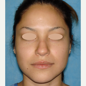 18-24 year old woman treated with Rhinoplasty before 3660147