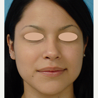 18-24 year old woman treated with Rhinoplasty after 3660147