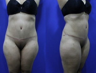 Abdominoplasty (aka Tummy Tuck) 1252407