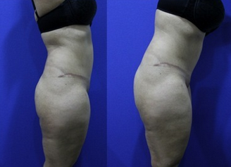 Abdominoplasty (aka Tummy Tuck) 1252407