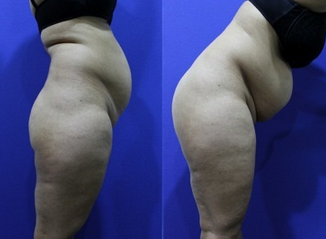 Abdominoplasty (aka Tummy Tuck) after 1252407