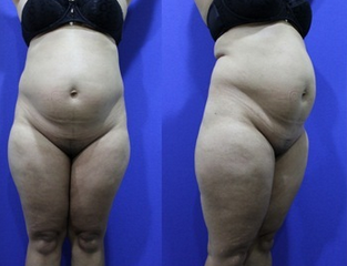 Abdominoplasty (aka Tummy Tuck) before 1252407