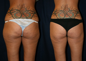 SmartLipo before 996923
