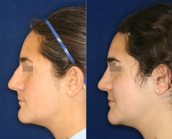 Nose Surgery before 1430590