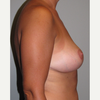 35-44 year old woman treated with Breast Lift after 3134458