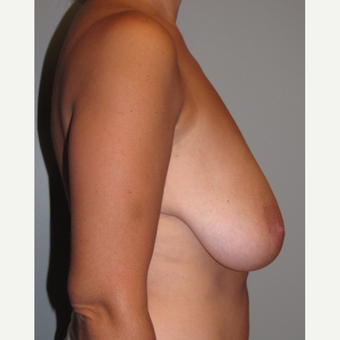 35-44 year old woman treated with Breast Lift before 3134458