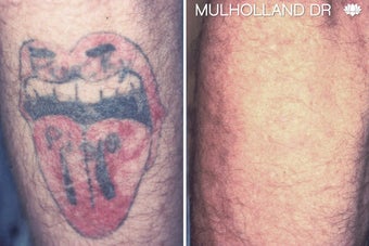 PicoSure Laser Tattoo Removal before 1440001