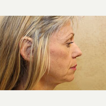 Facelift before 3454855