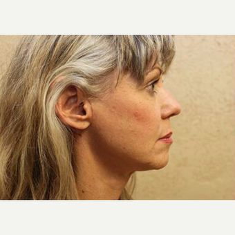 Facelift after 3454855