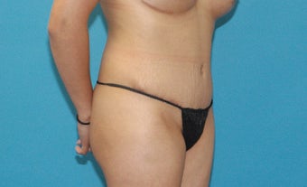 30 year old woman treated with Tummy Tuck after 3004984