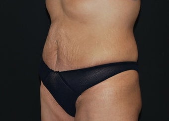 CoolSculpting after 1514606