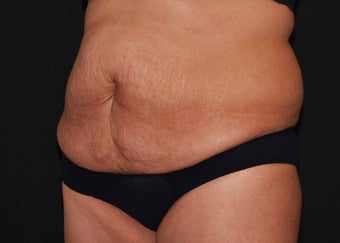 CoolSculpting before 1514606