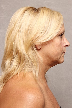 Fat Transfer before 1392796