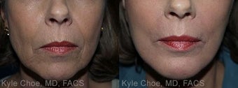Dermabrasion for vertical upper lip lines before 1459562