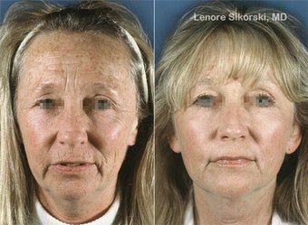 Upper Blepharoplasty and Full Face Laser Resurfacing before 106313