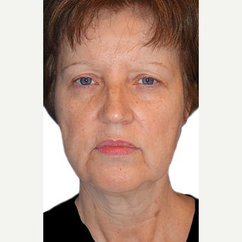 65 year old woman treated with Brow Lift before 3548712