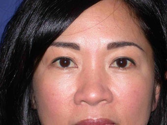 Eye bags treatment: Fat transfer to tear troughs after 83398