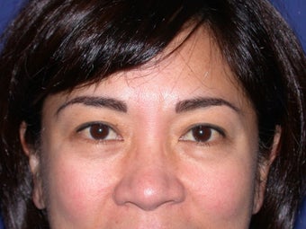 Eye bags treatment: Fat transfer to tear troughs before 83398
