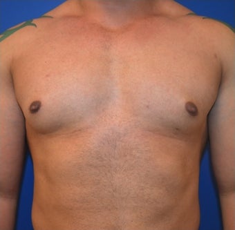 Young Male Treated for Large Breasts before 1367257