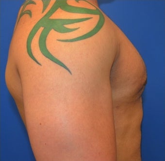 Young Male Treated for Large Breasts 1367257