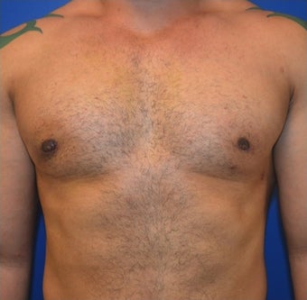 Young Male Treated for Large Breasts after 1367257