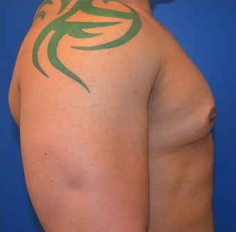 Young Male Treated for Large Breasts 1367257
