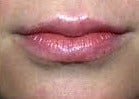 25-34 year old woman treated with Lip Augmentation after 2986744