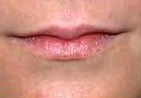 25-34 year old woman treated with Lip Augmentation before 2986744