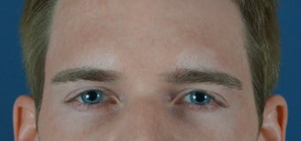 27 year old treated with filler to improve the hallowness in the temples after 782175