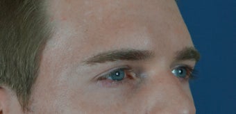 27 year old treated with filler to improve the hallowness in the temples 782175