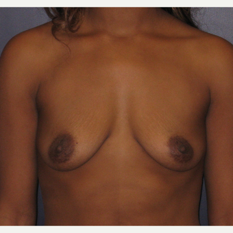 25-34 year old woman treated with Breast Augmentation before 3455181