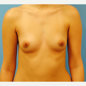 25-34 year old woman treated with Breast Augmentation before 3061639