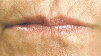 Facial Fillers- Lips before 566722