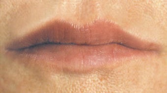 Facial Fillers- Lips after 566722