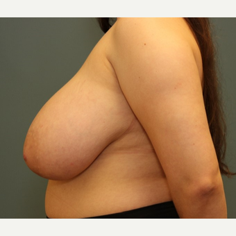 25-34 year old woman requesting a Breast Reduction before 3084482