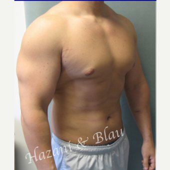 18-24 year old man treated with Male Breast Reduction before 3332934