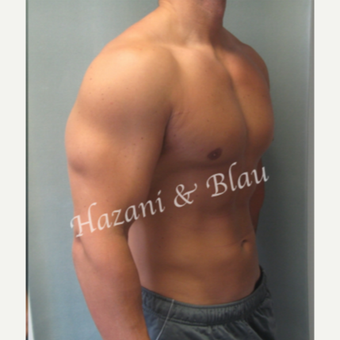 18-24 year old man treated with Male Breast Reduction after 3332934