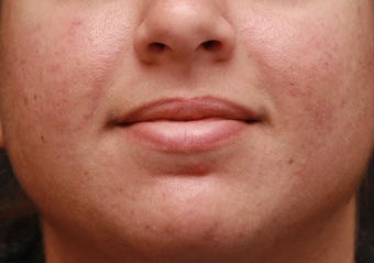 Photodynamic Therapy for Acne after 110229