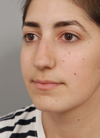 Rhinoplasty performed on 22 year old woman to correct a twisted and uneven nose before 2856130