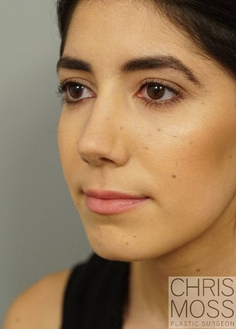 Rhinoplasty performed on 22 year old woman to correct a twisted and uneven nose after 2856130